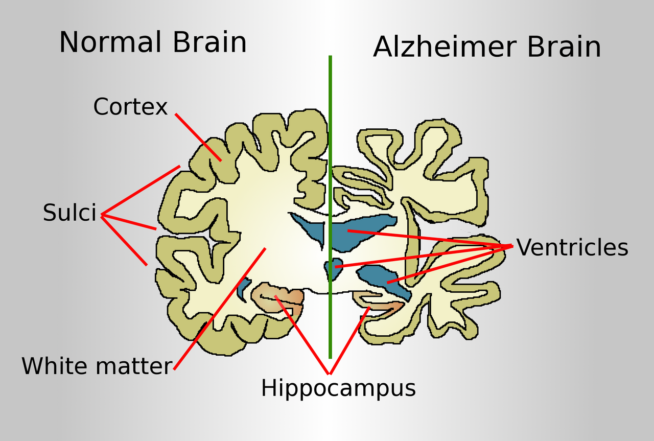 Alzheimer's Disease: after “seoExtra”, what about “why”?