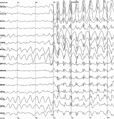 Epilepsy: after “Educational atlas — not a diagnosis, treatment plan, or medical ”, what about “Epilepsy: prefer mechanisms and dated bands