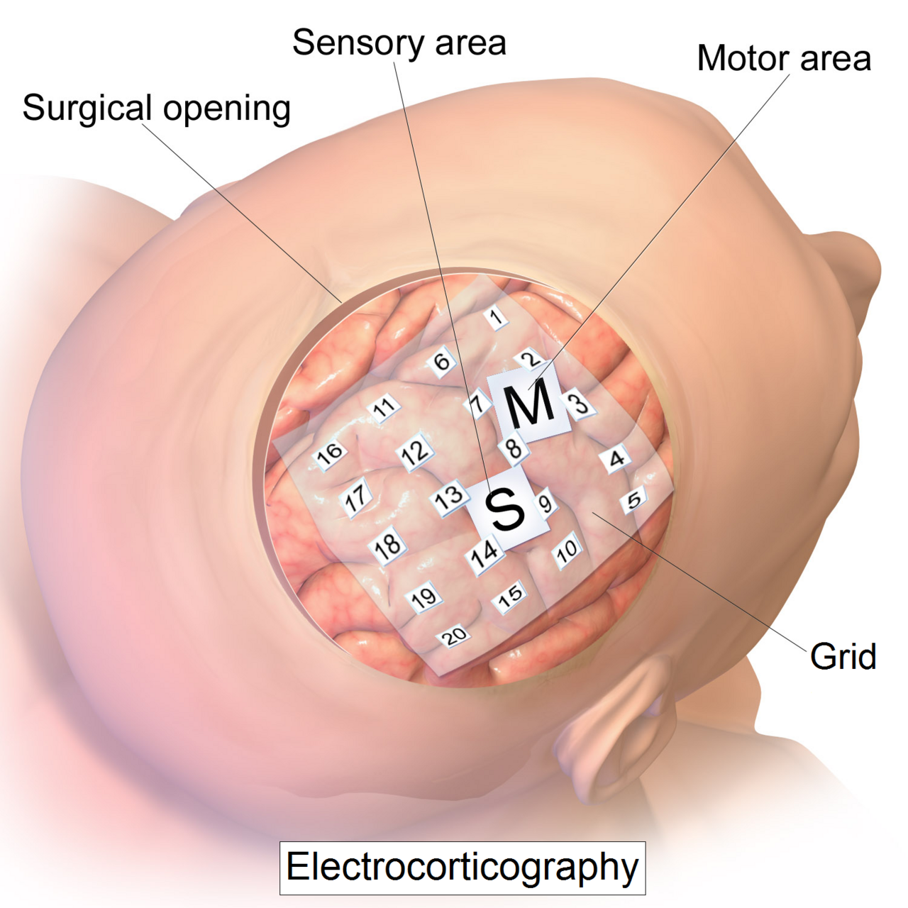 Intracranial EEG: after “tagline”, what about “Intracranial EEG records electrical activity from electrodes on ”?