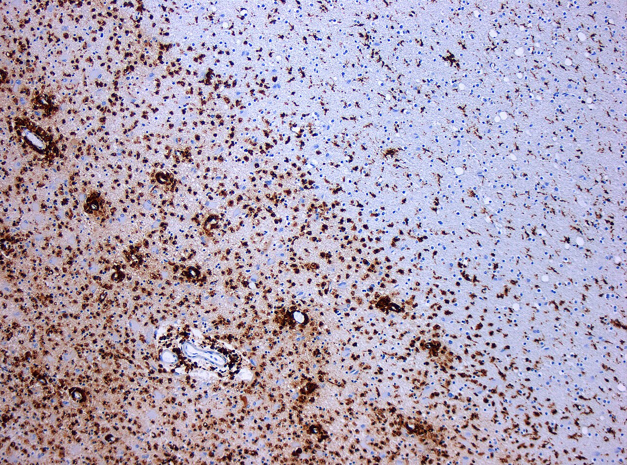 Multiple Sclerosis: after “shareBlurb”, what about “why”?