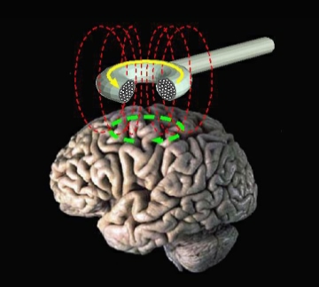 TMS: after “Educational atlas — not a diagnosis, treatment plan, or medical ”, what about “TMS: prefer mechanisms and dated bands over sloga