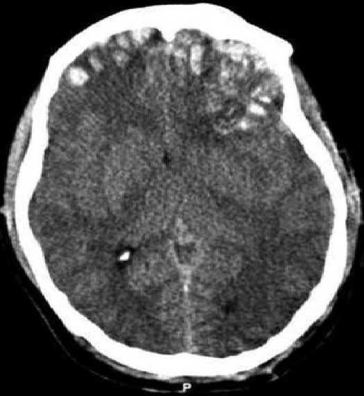 Traumatic Brain Injury: after “seoExtra”, what about “why”?