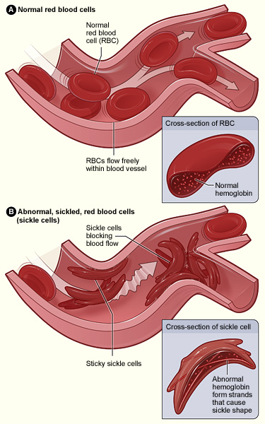 Illustration related to Malaria adaptations