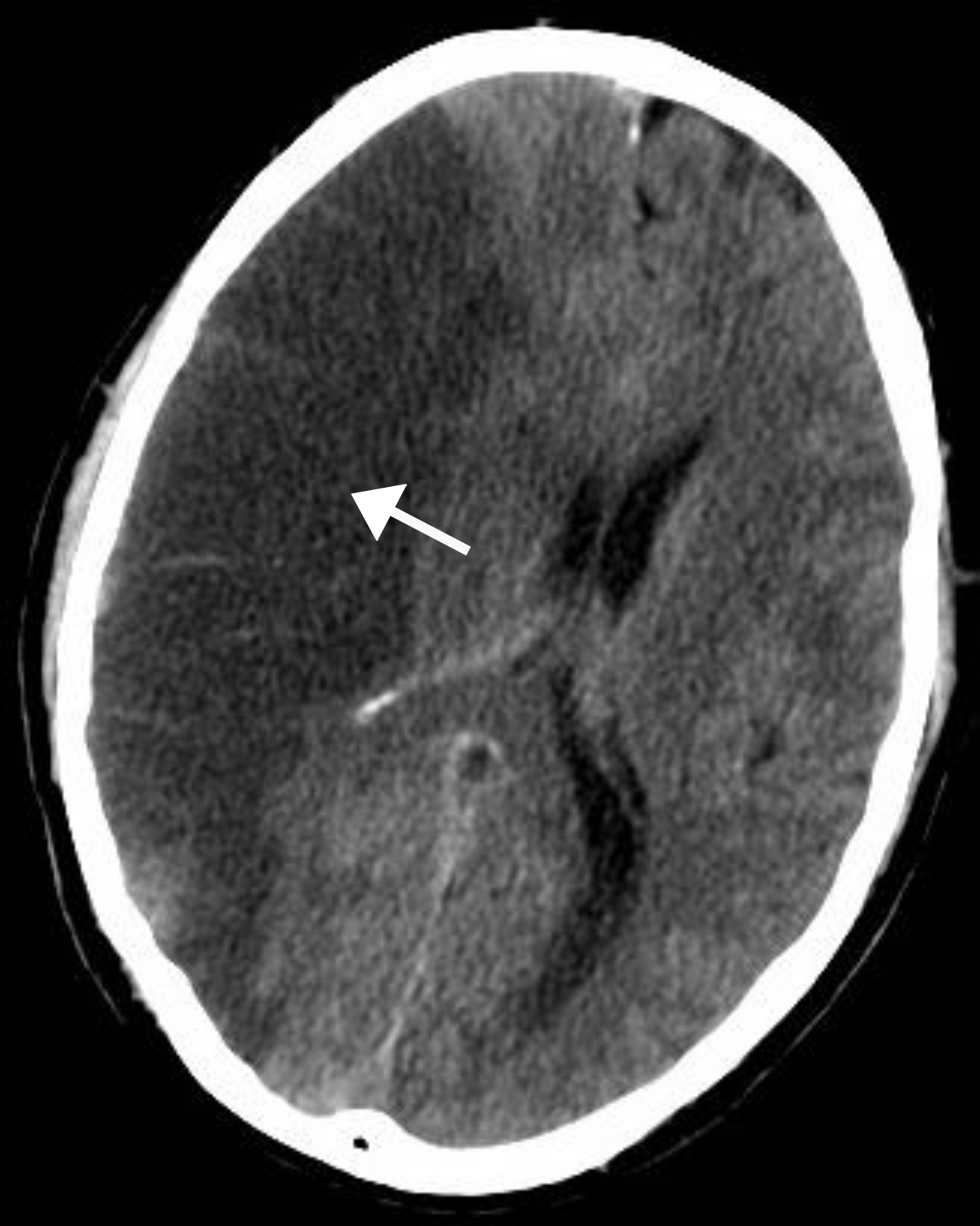 Post-Stroke: after “A stroke occurs when blood flow to part of the brain is interrup”, what about “Rehabilitation after stroke relies heavil