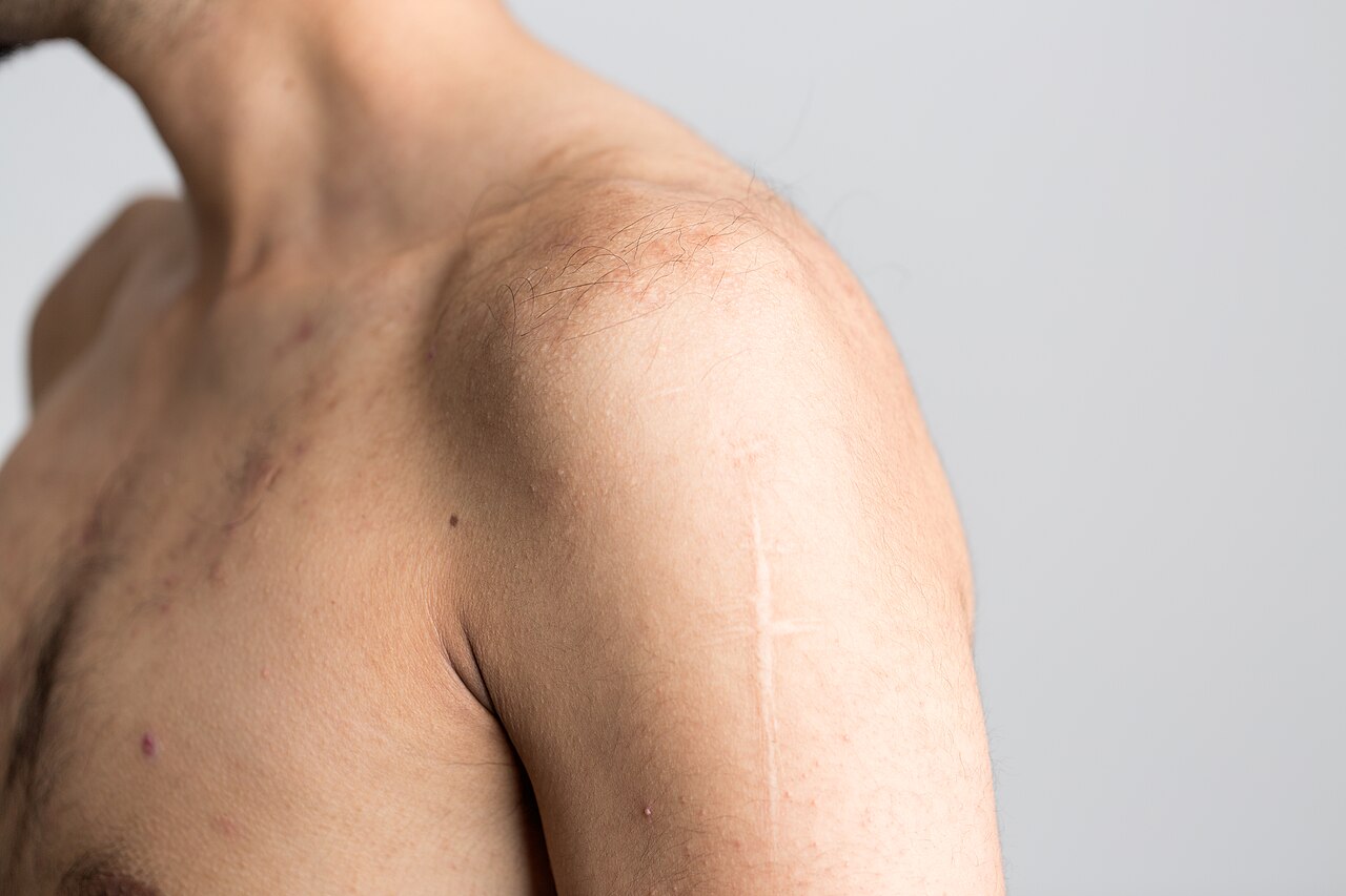 Shoulder: after “The shoulder is the most mobile joint in the human body, formed ”, what about “Shoulder pain is among the most common muscu